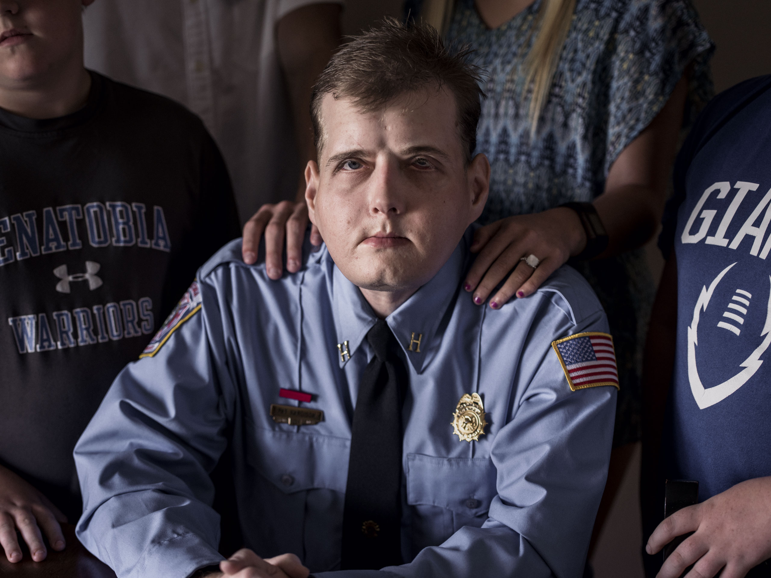 Patrick Hardison, 42, received the most extensive face transplant ever, after suffering massive burns as a volunteer firefighter