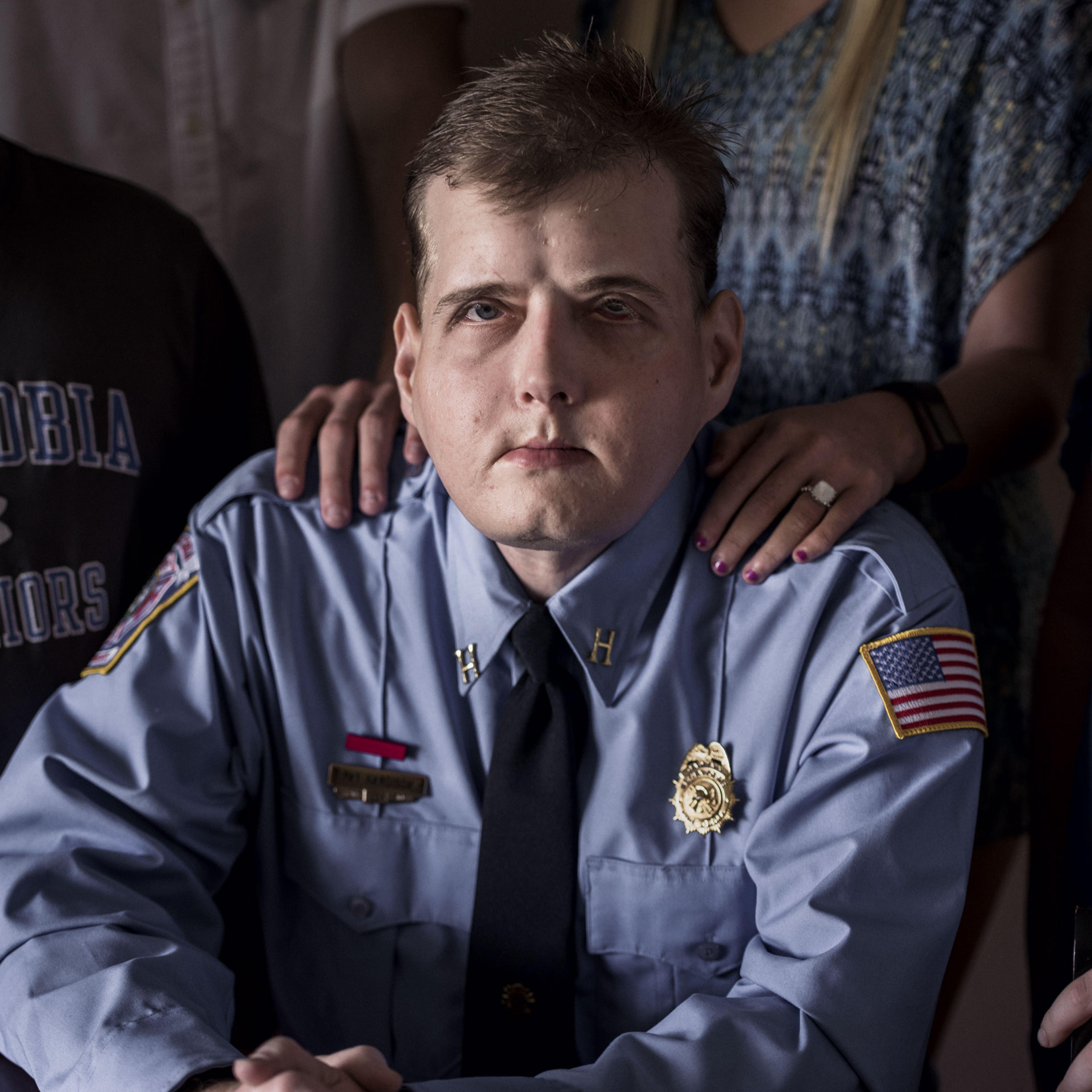 Patrick Hardison, 42, received the most extensive face transplant ever, after suffering massive burns as a volunteer firefighter