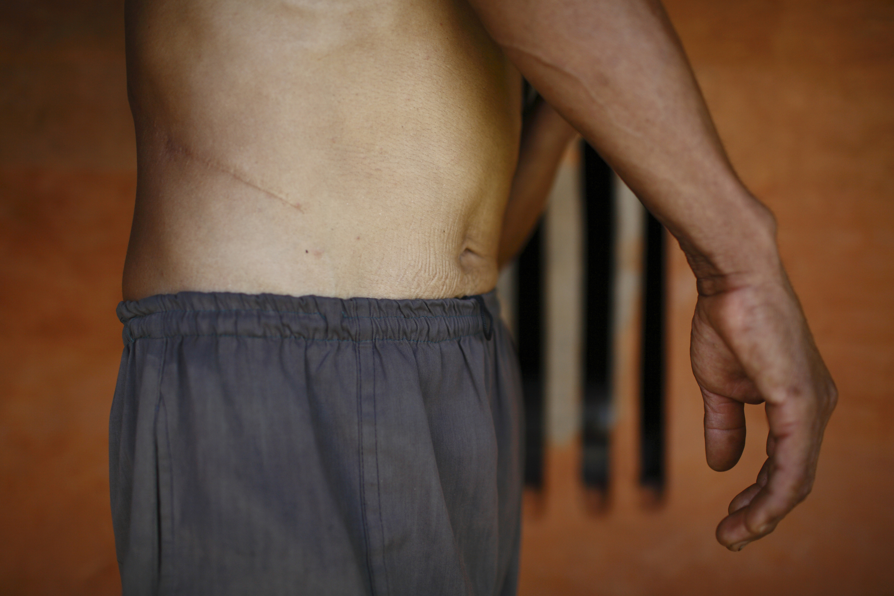 Man Bahadur Tamang, 51, who sold his kidney for 64,000 Nepalese rupees ($727) due to poverty, shows the incision scar from the operation, at his home in Kavre