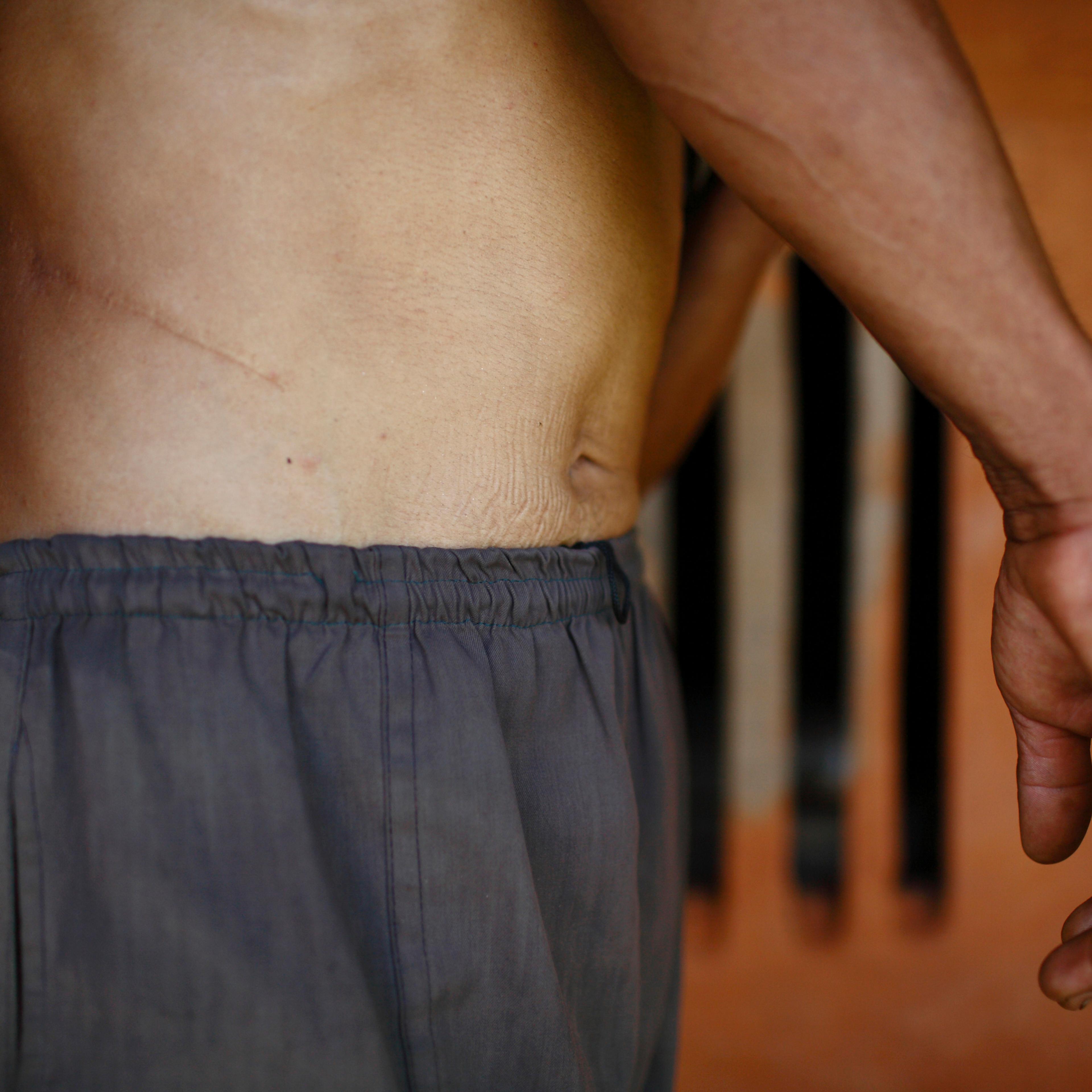 Man Bahadur Tamang, 51, who sold his kidney for 64,000 Nepalese rupees ($727) due to poverty, shows the incision scar from the operation, at his home in Kavre