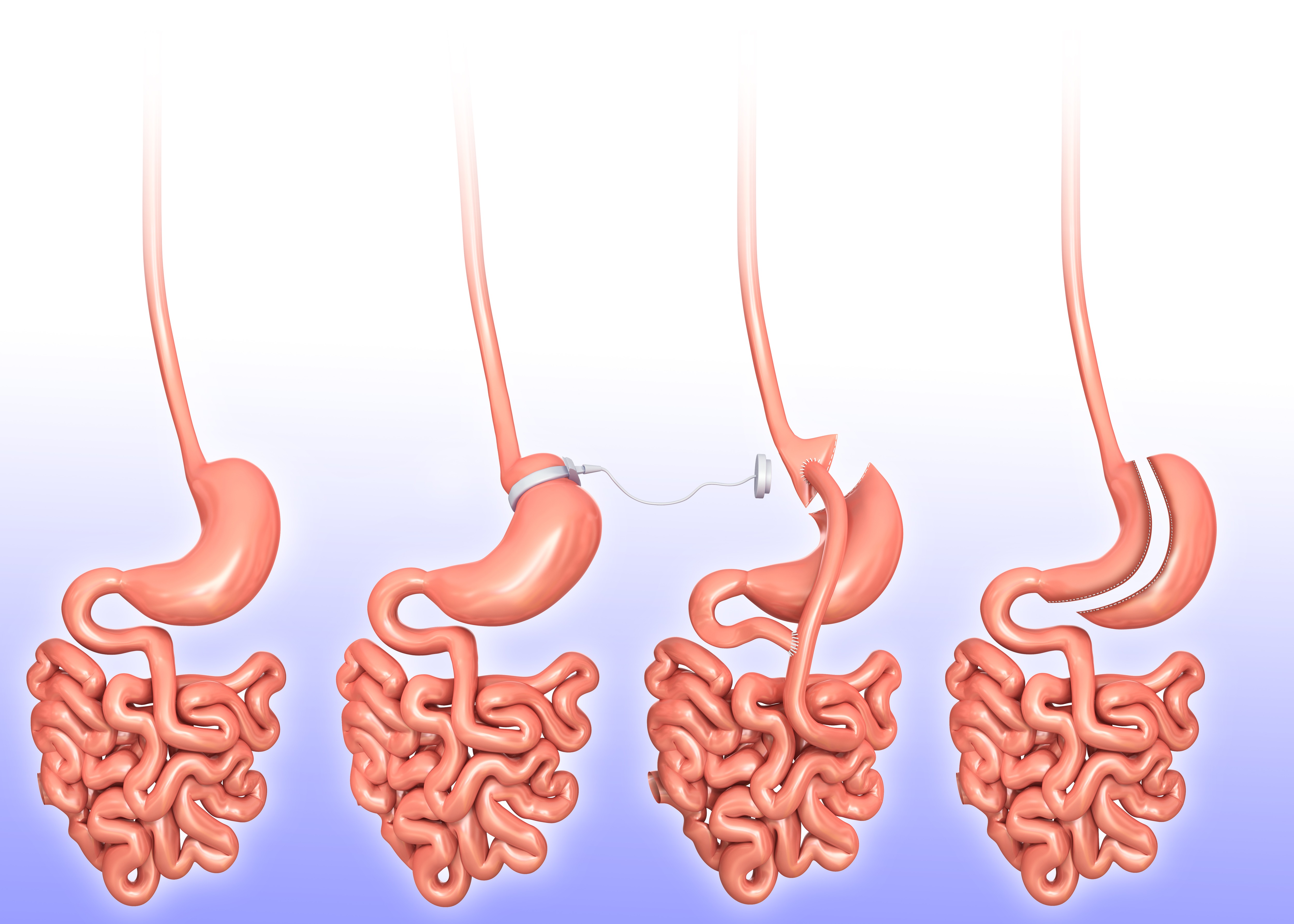 Weight loss surgery, illustration
