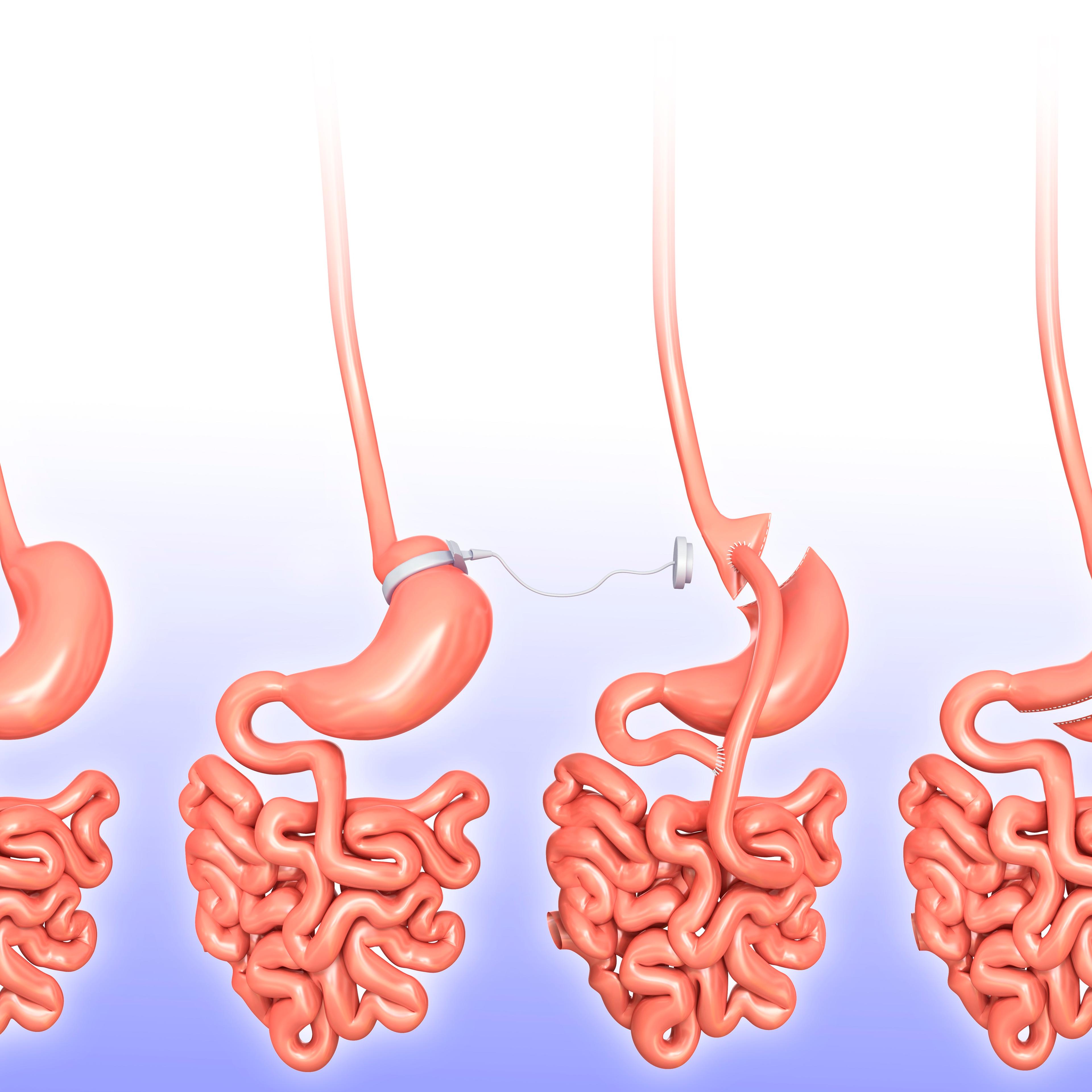 Weight loss surgery, illustration