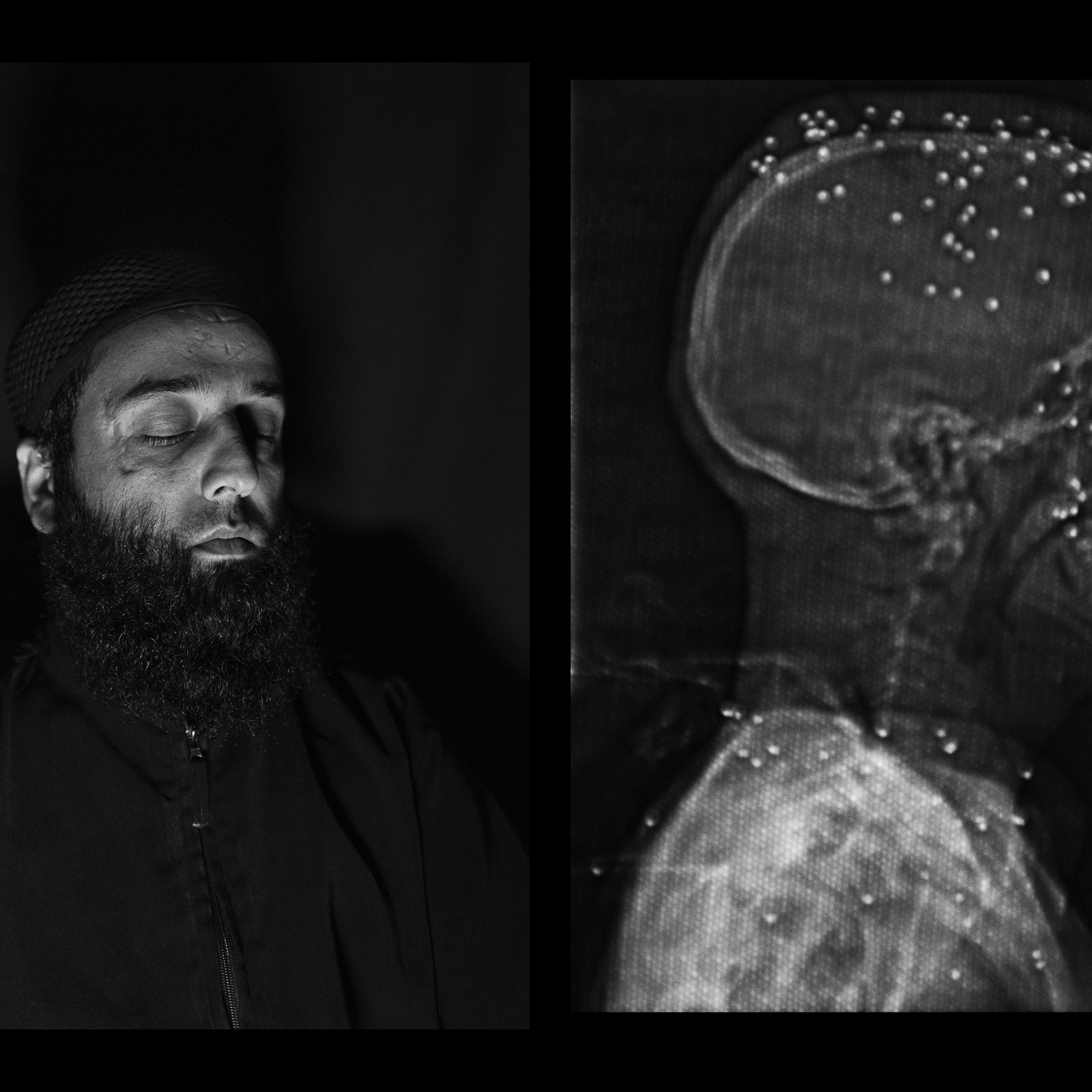 Amir Kabir Beigh, 26 years old, Baramulla. “I have gone through a lot of surgeries all over India but I am still completely blind".