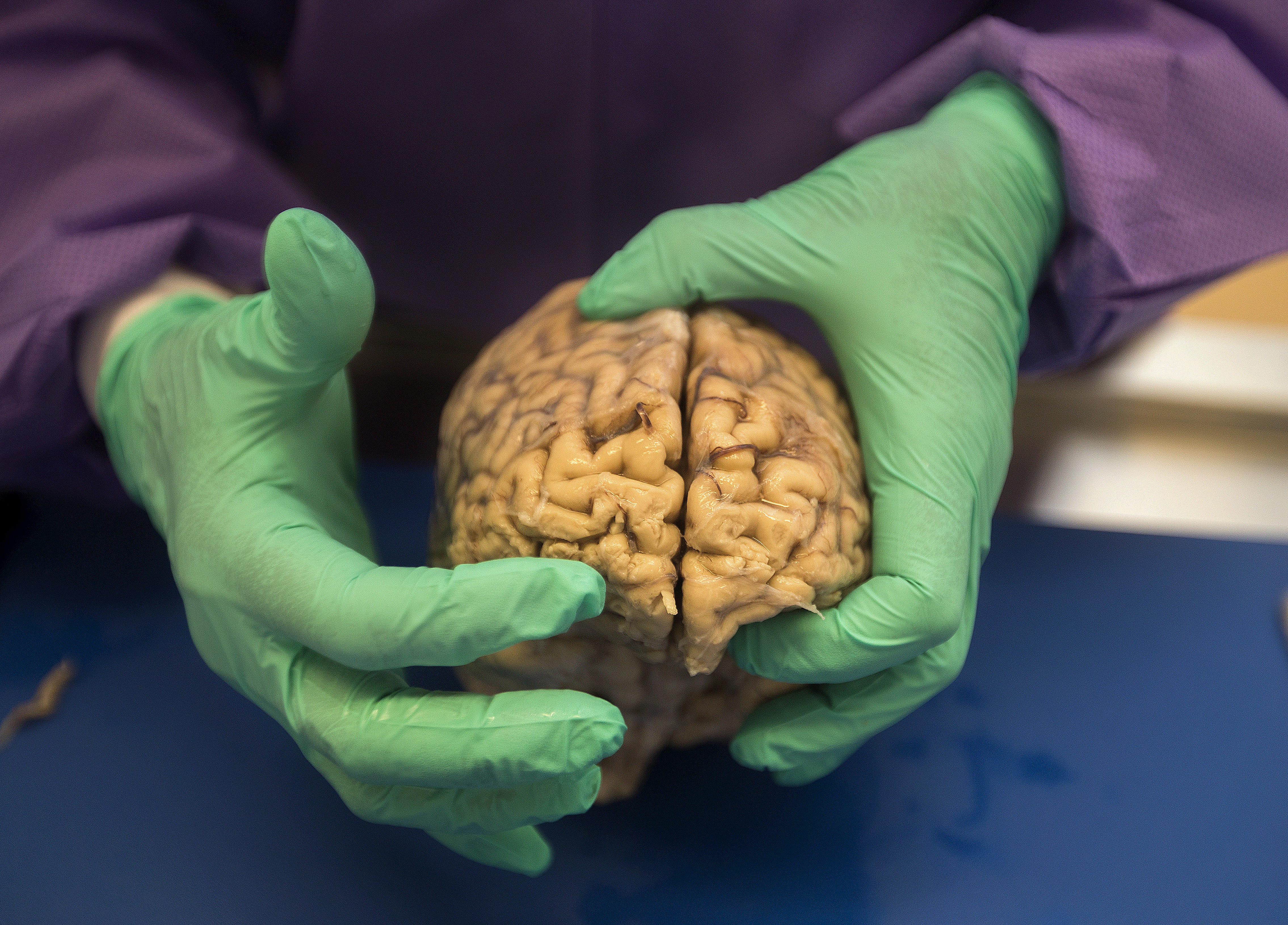 CTE brain