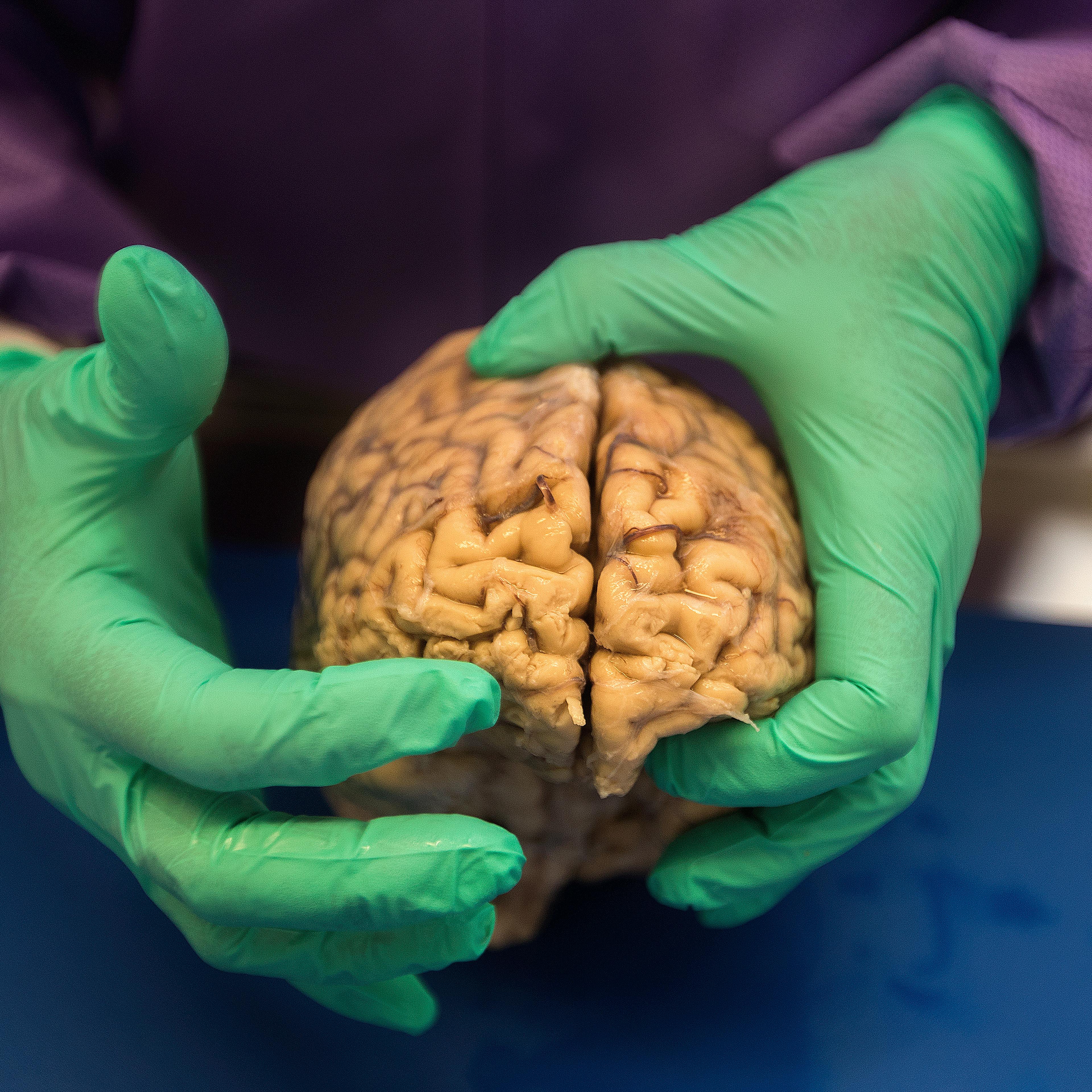 CTE brain