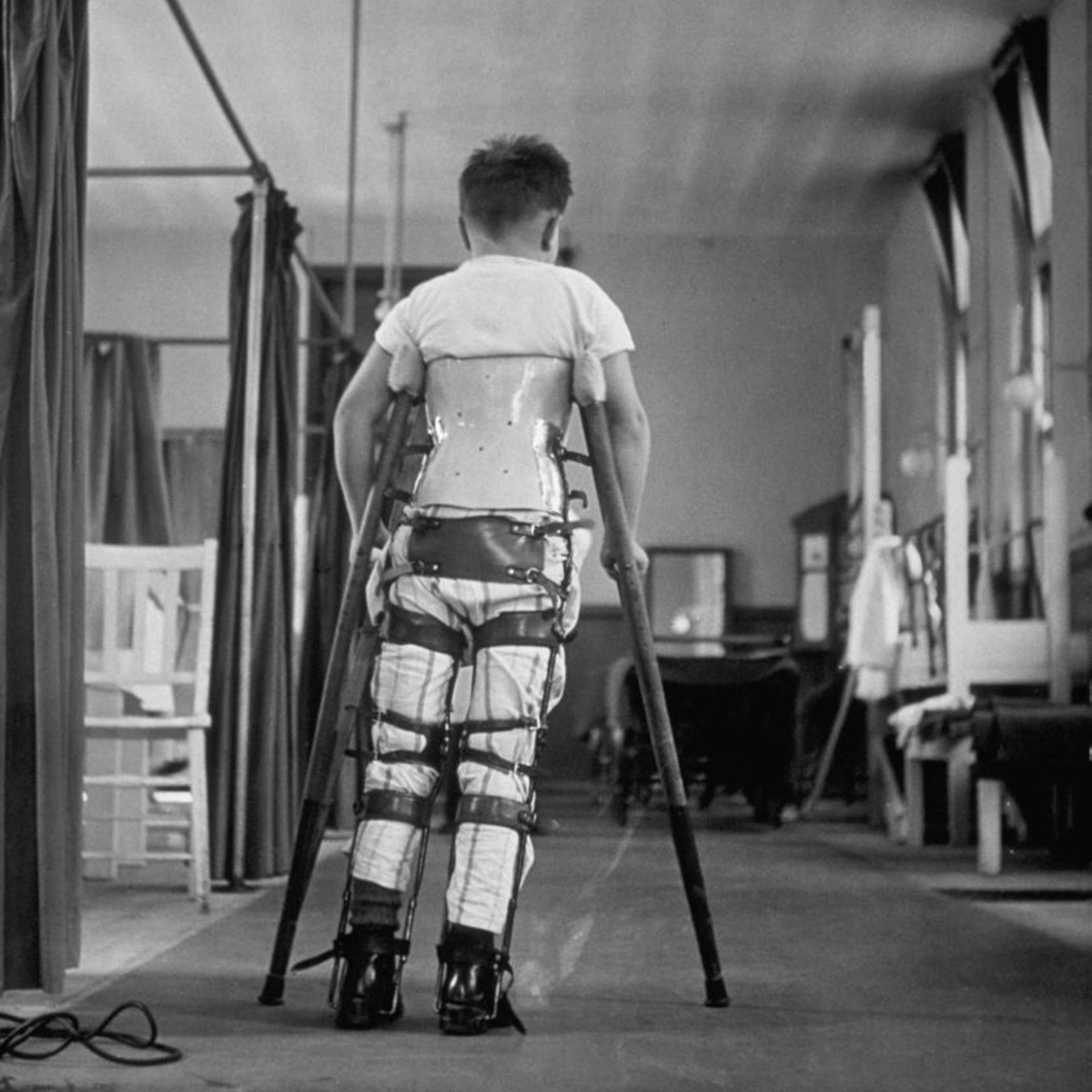 A child with polio learns how to walk