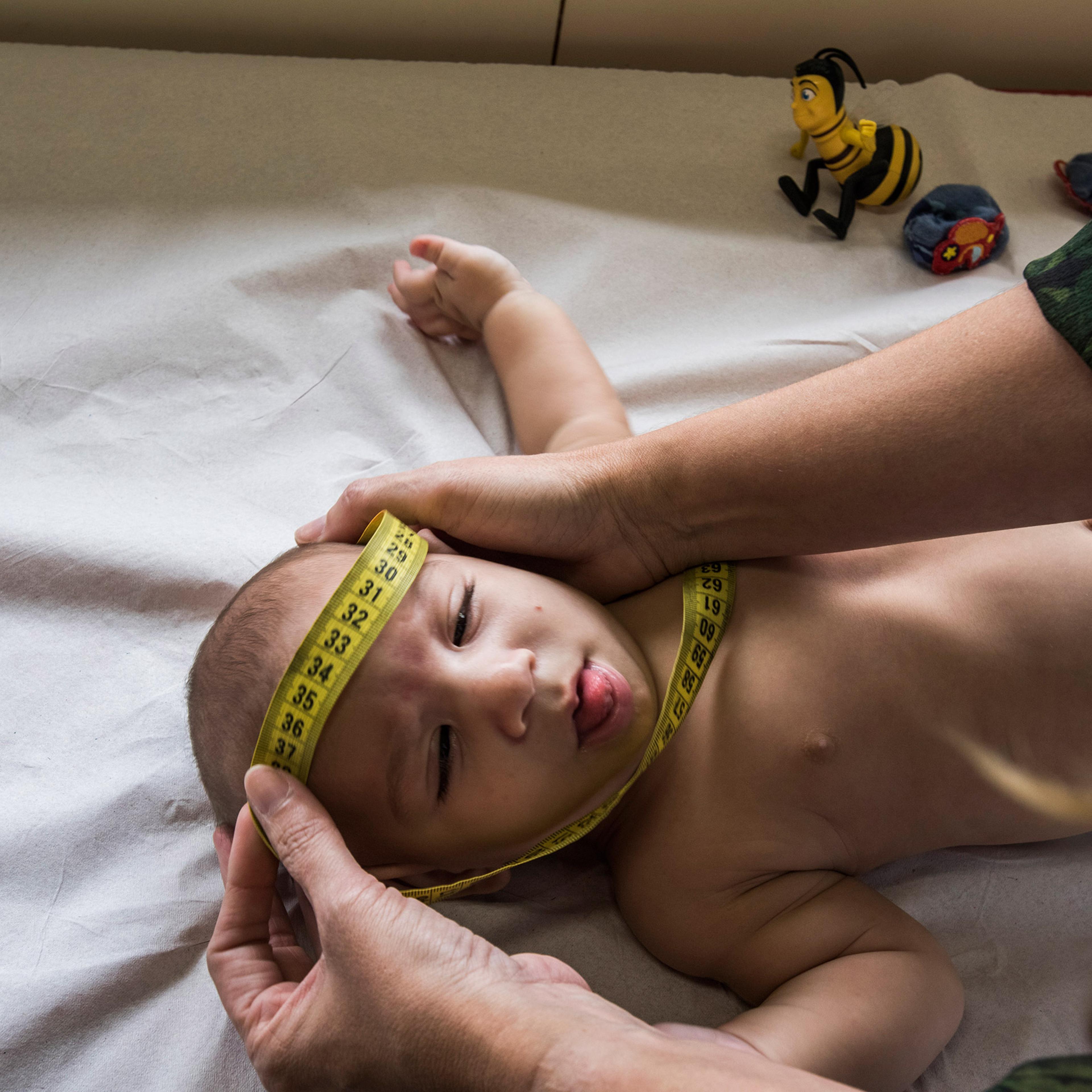 Dr. Vanessa Van Der Linden, a neurologist at the Associacao de Assistencia a Crianca Deficiente, measures the head of a baby with microcephaly in Recife, Brazil, Feb. 1, 2016. This center has seen 69 children with microcephaly so far.