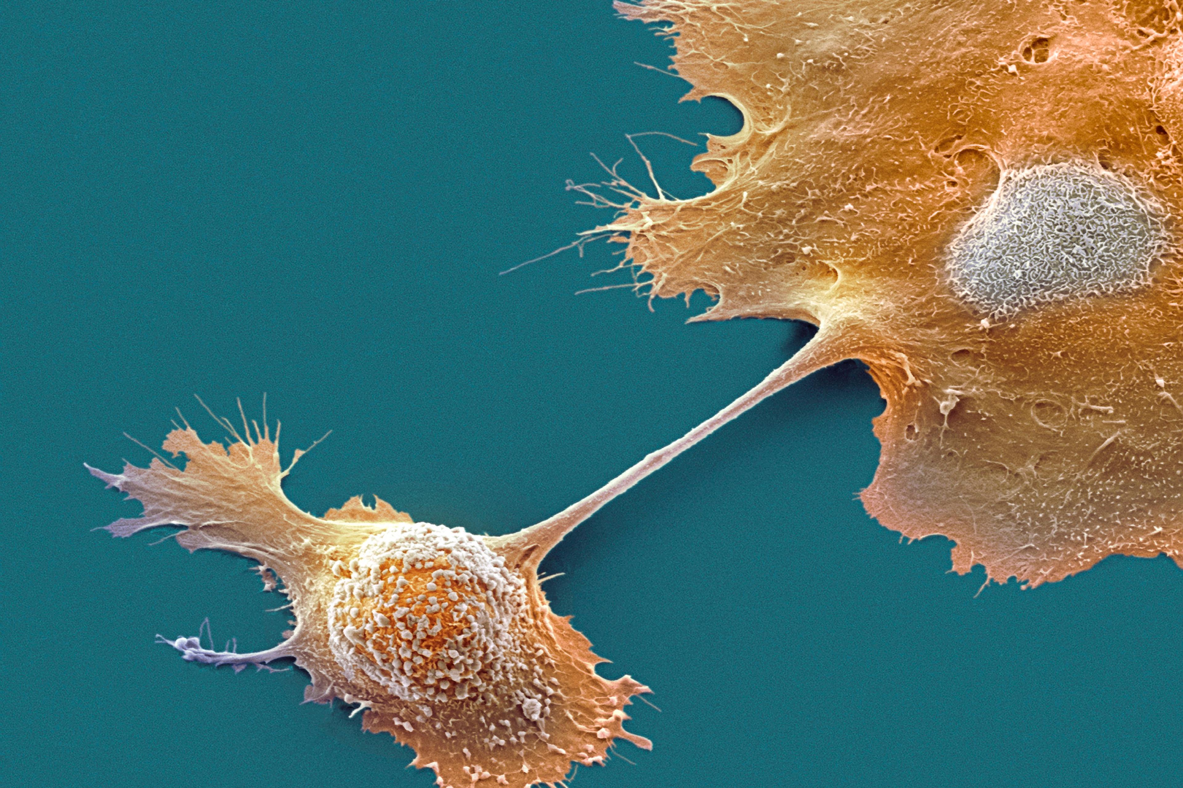 Two New Drugs Offer Hope for Pancreatic Cancer