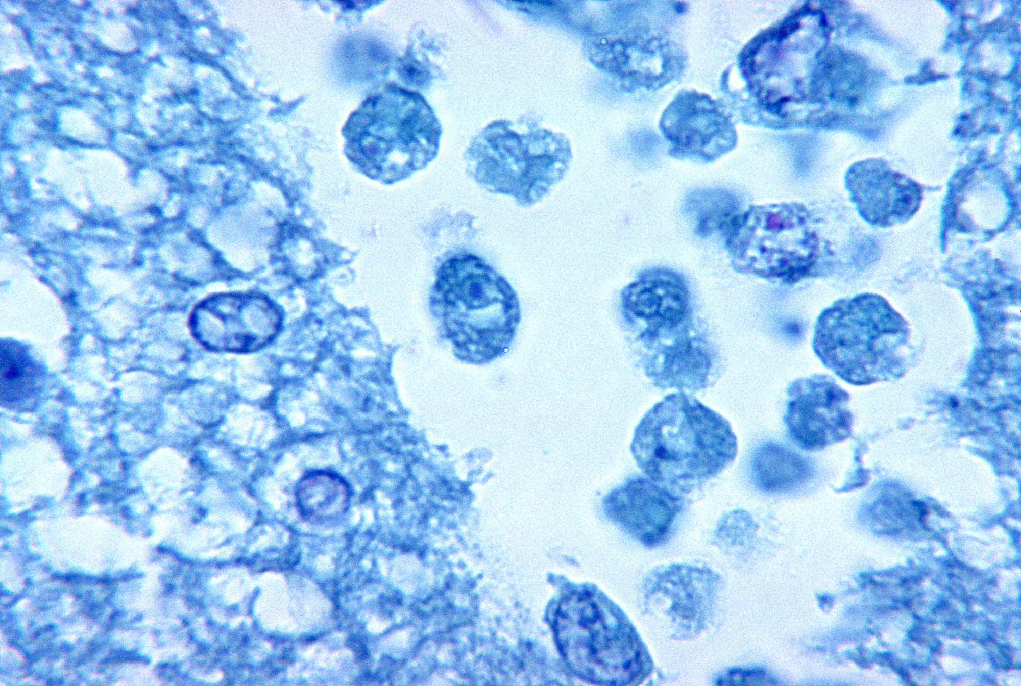 This photomicrograph of a brain tissue specimen depicts the cytoarchitectural changes associated with a free-living, Naegleria fowleri, amebic infection.