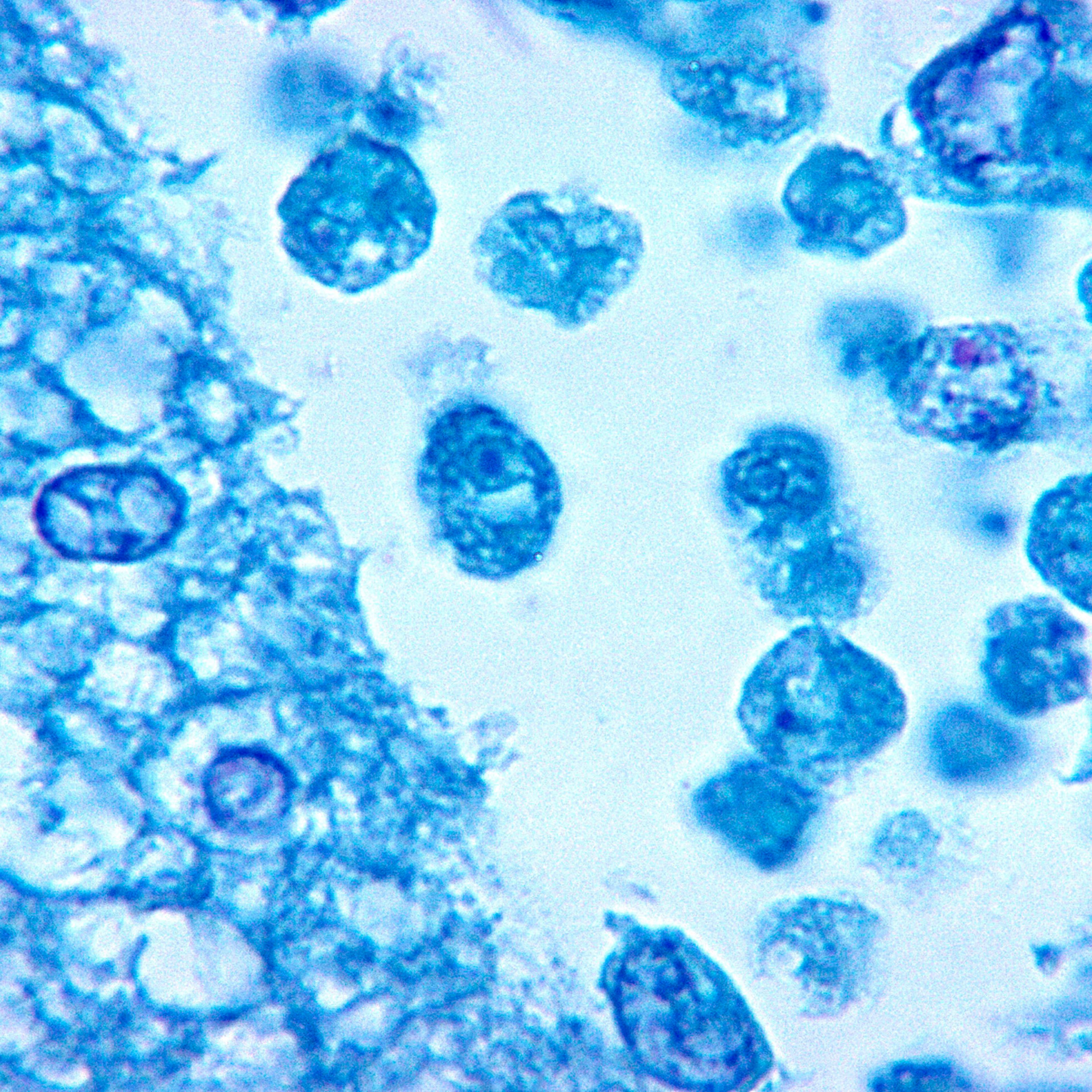 This photomicrograph of a brain tissue specimen depicts the cytoarchitectural changes associated with a free-living, Naegleria fowleri, amebic infection.