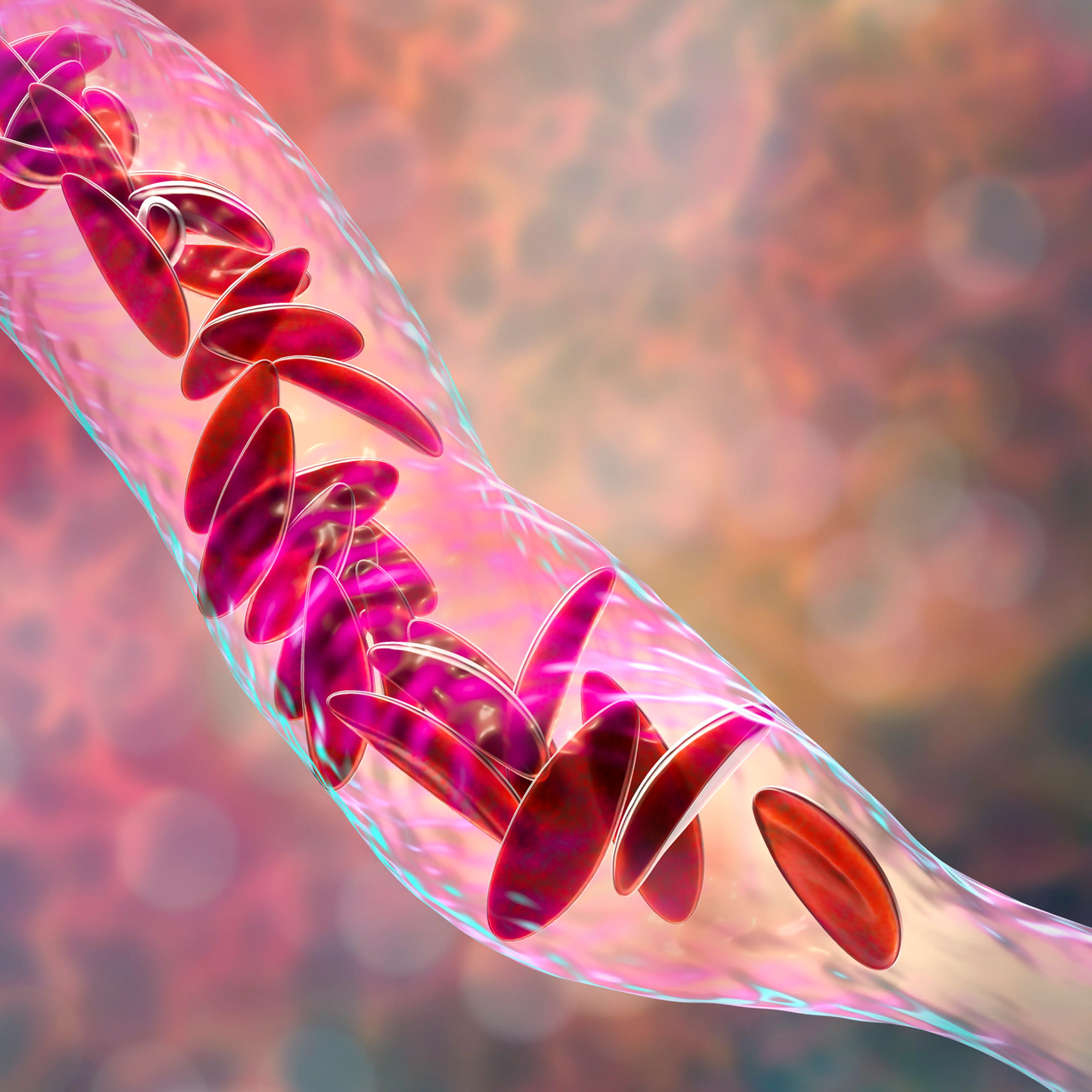 Sickle cell anemia