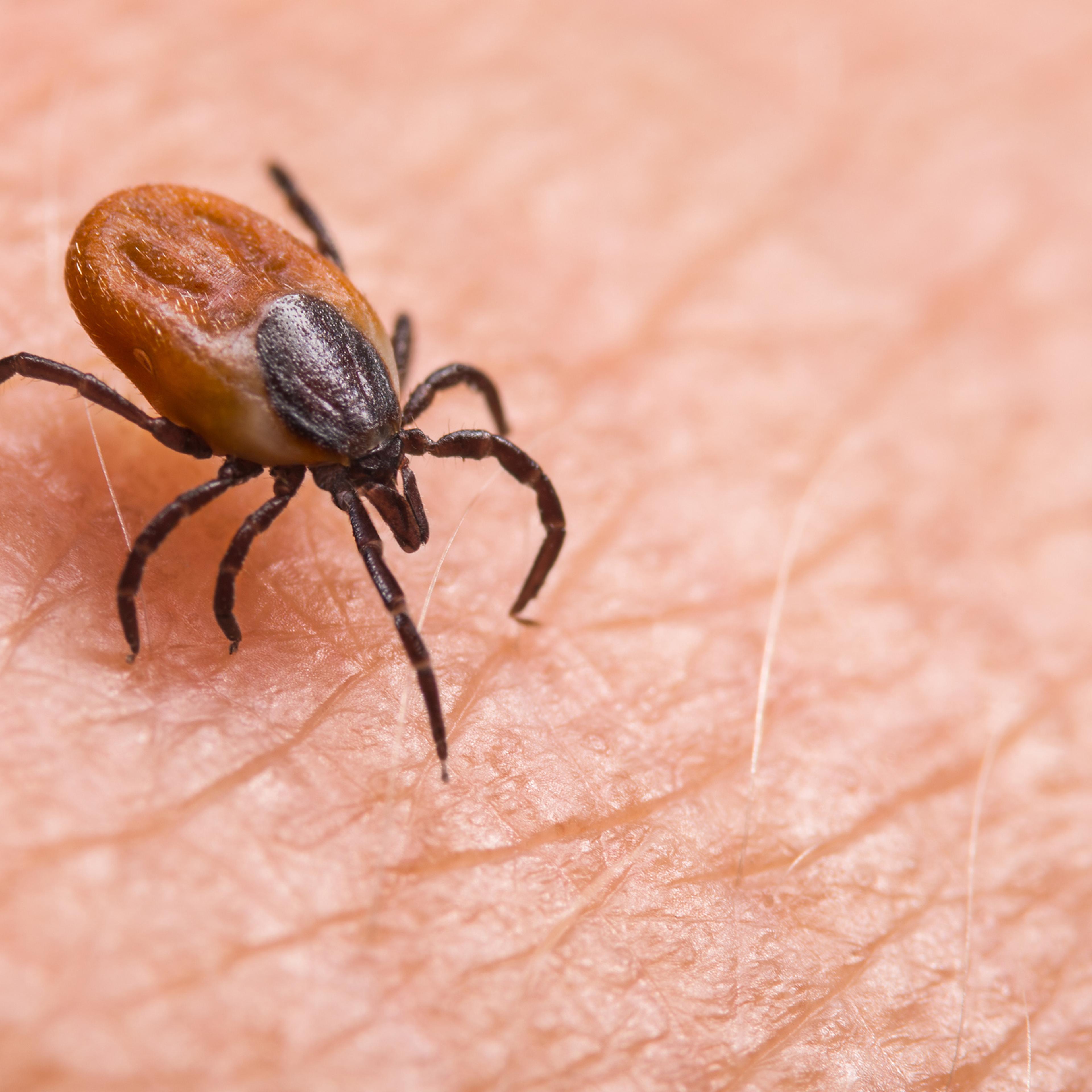 Infected female deer tick on hairy human skin. Ixodes ricinus. Dangerous mite detail. Acarus. Infectious borreliosis