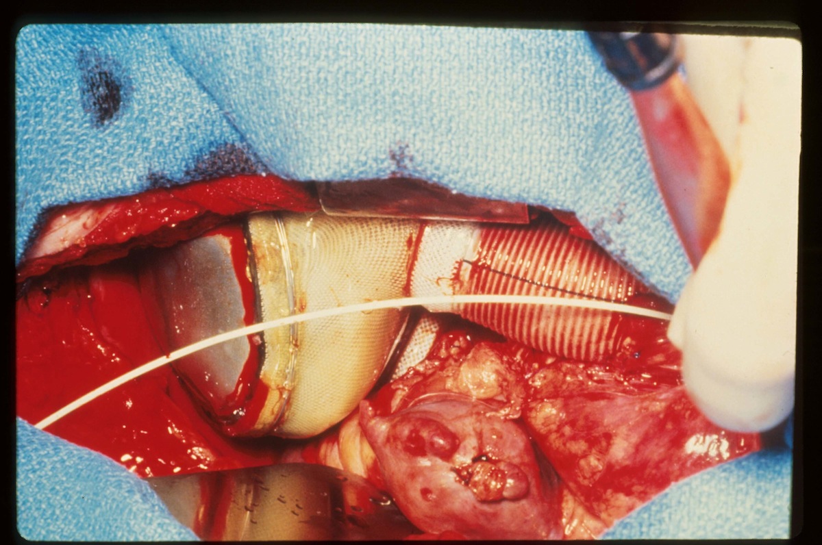 First Artificial Heart Implantation