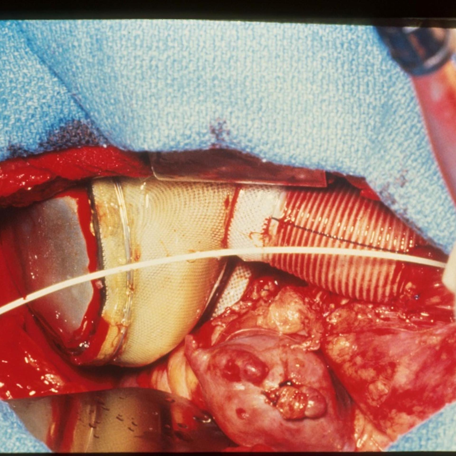 First Artificial Heart Implantation