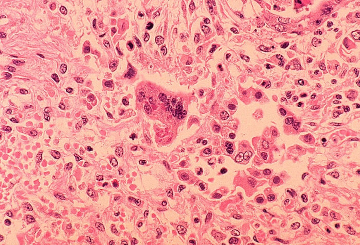 Measles Outbreaks Spread In U.S.