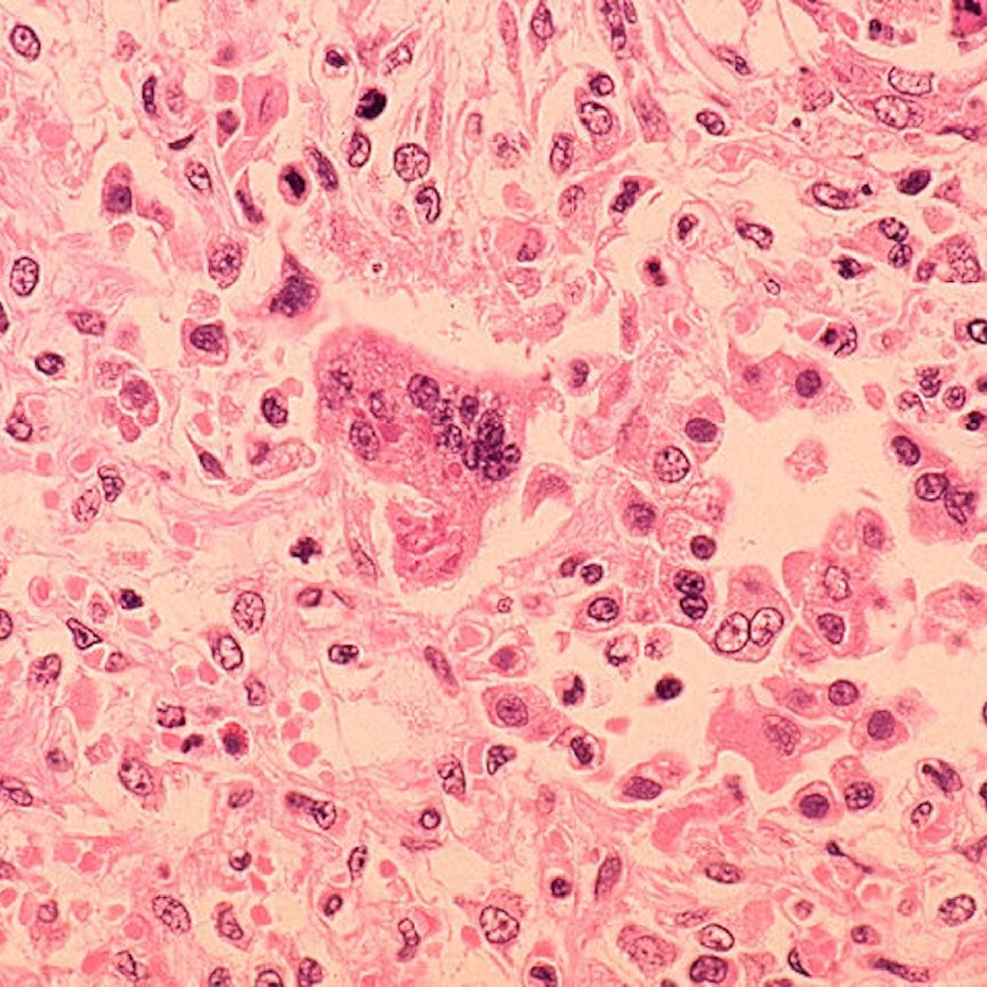 Measles Outbreaks Spread In U.S.