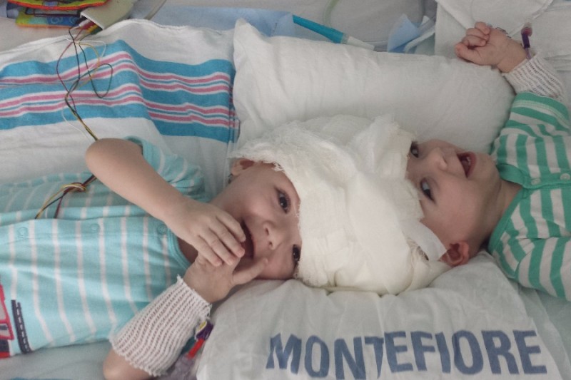 Anias and Jadon McDonald were born conjoined at the head, on Sept. 9, 2015.