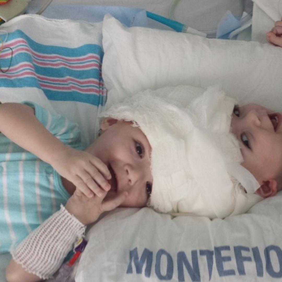 Anias and Jadon McDonald were born conjoined at the head, on Sept. 9, 2015.