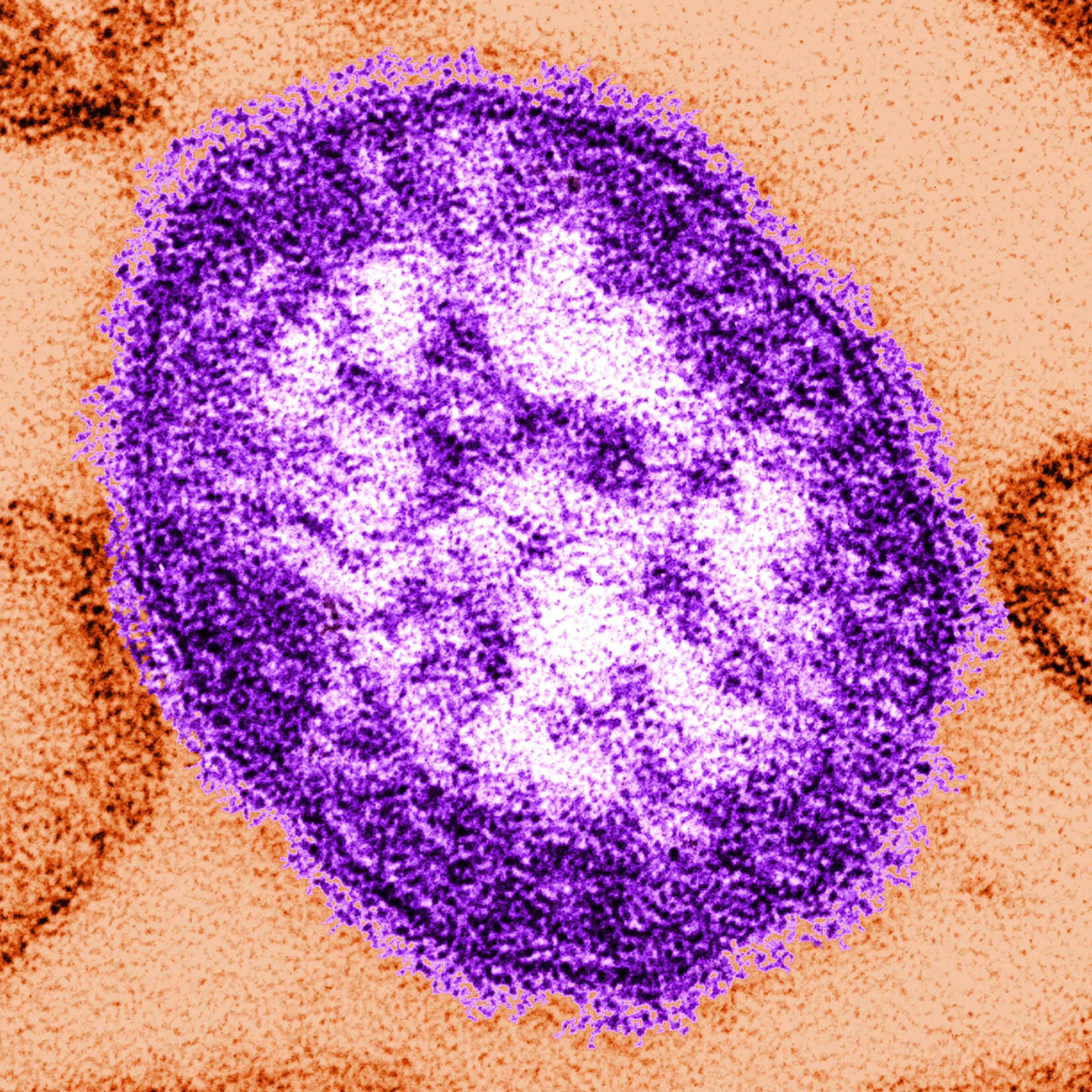 Measles Outbreaks Spread In U.S.