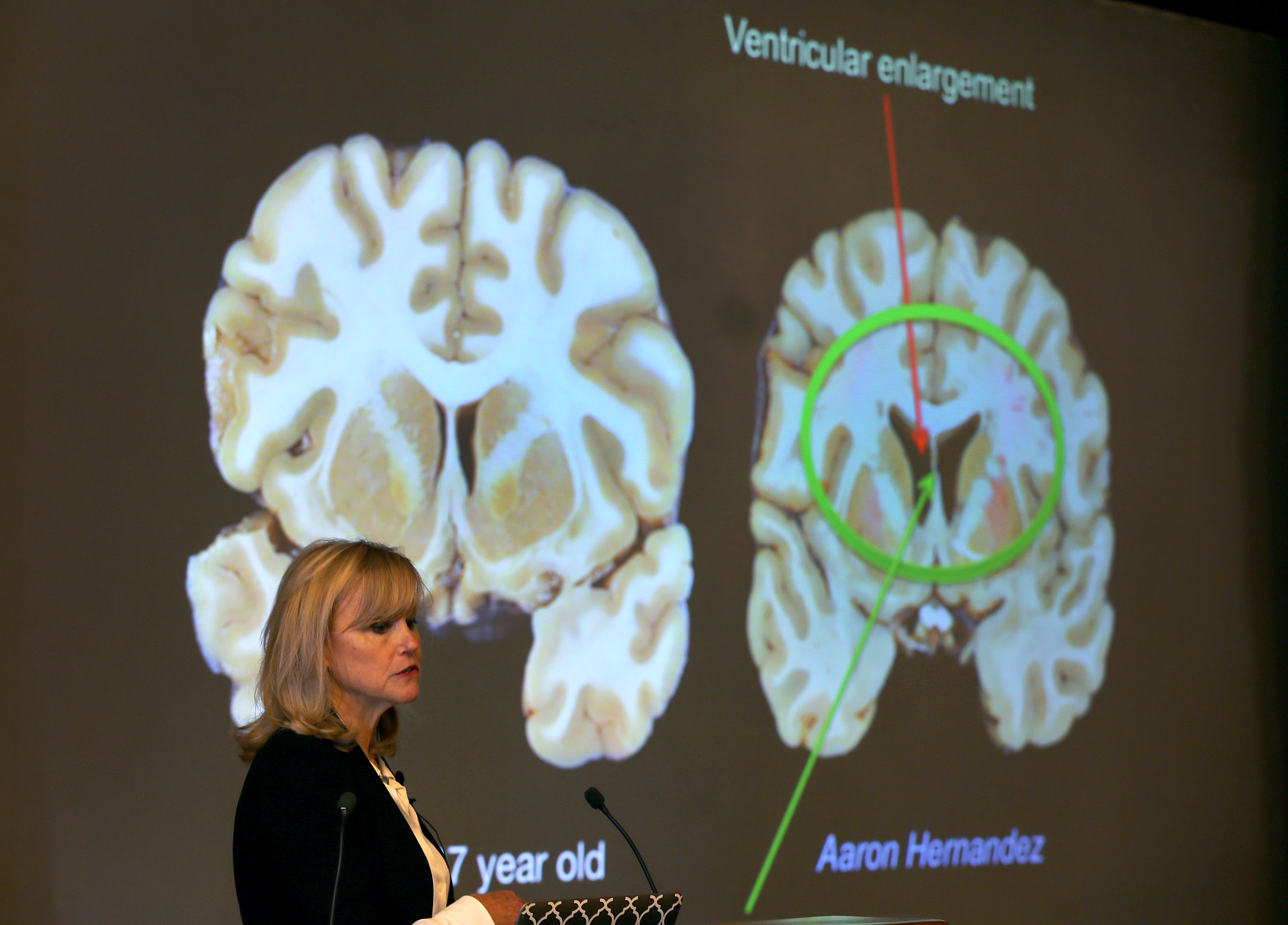 BU Researcher Confirms Aaron Hernandezs Brain Was Severely Afflicted By CTE