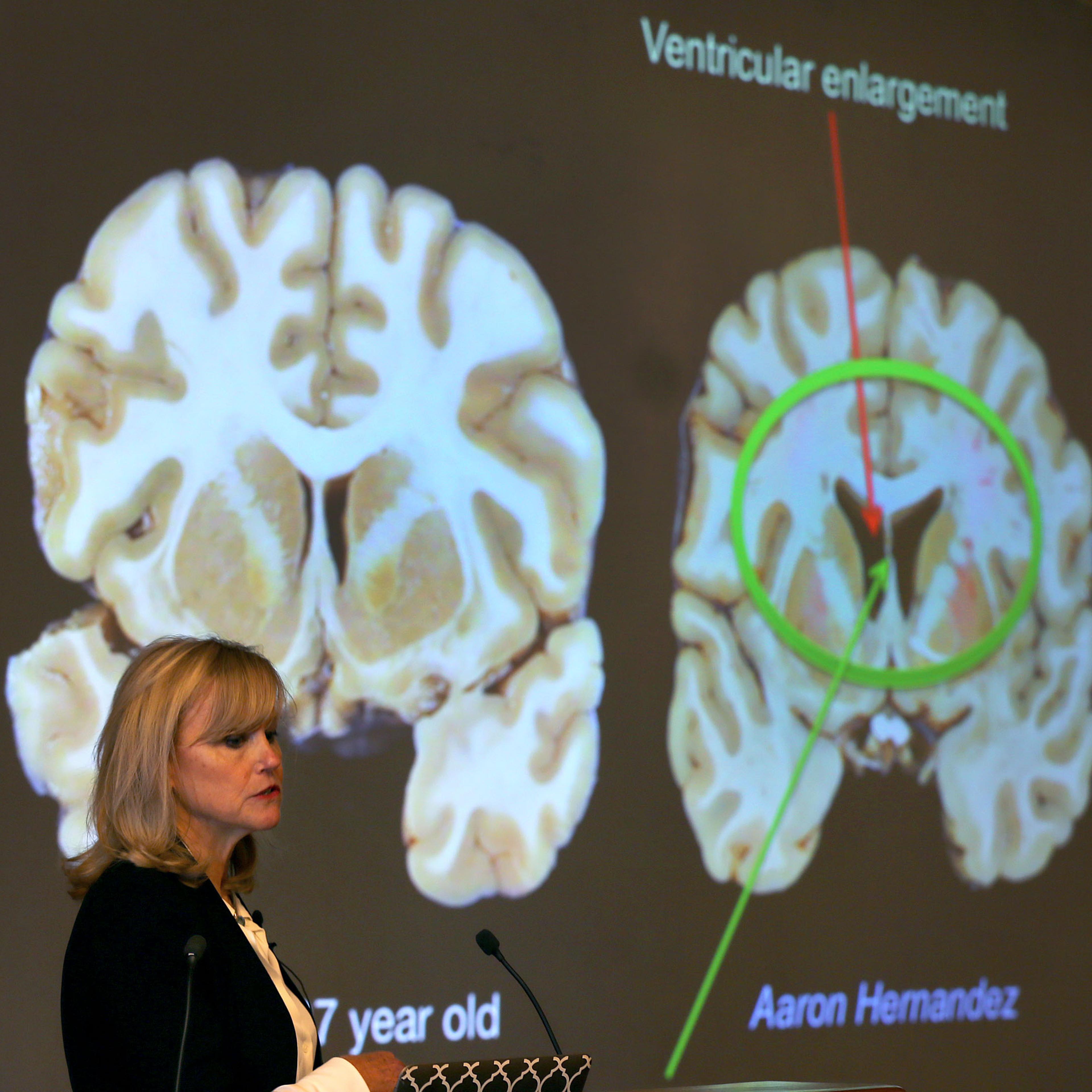 BU Researcher Confirms Aaron Hernandezs Brain Was Severely Afflicted By CTE