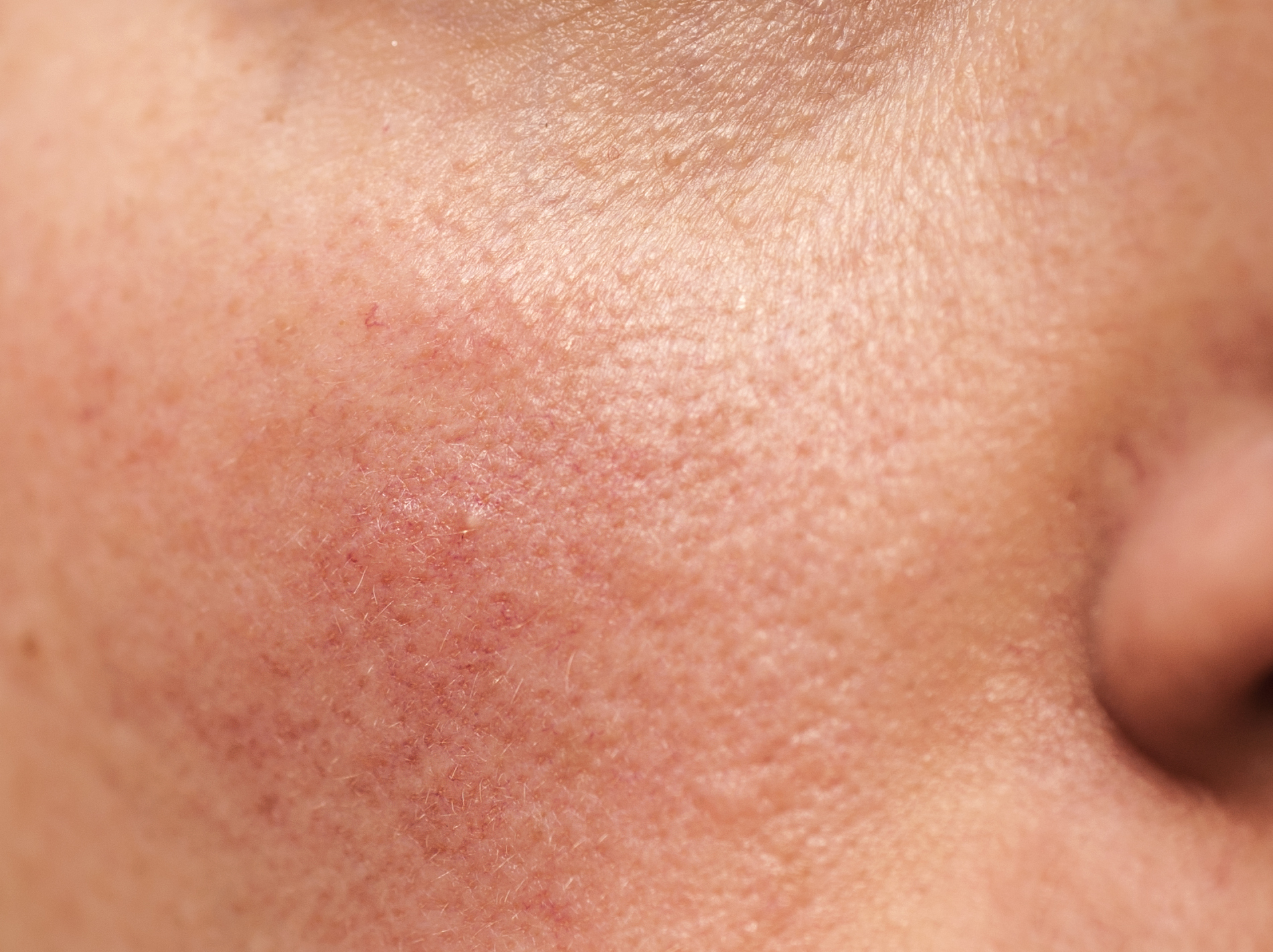 Rosacea on Skin TIME health stock