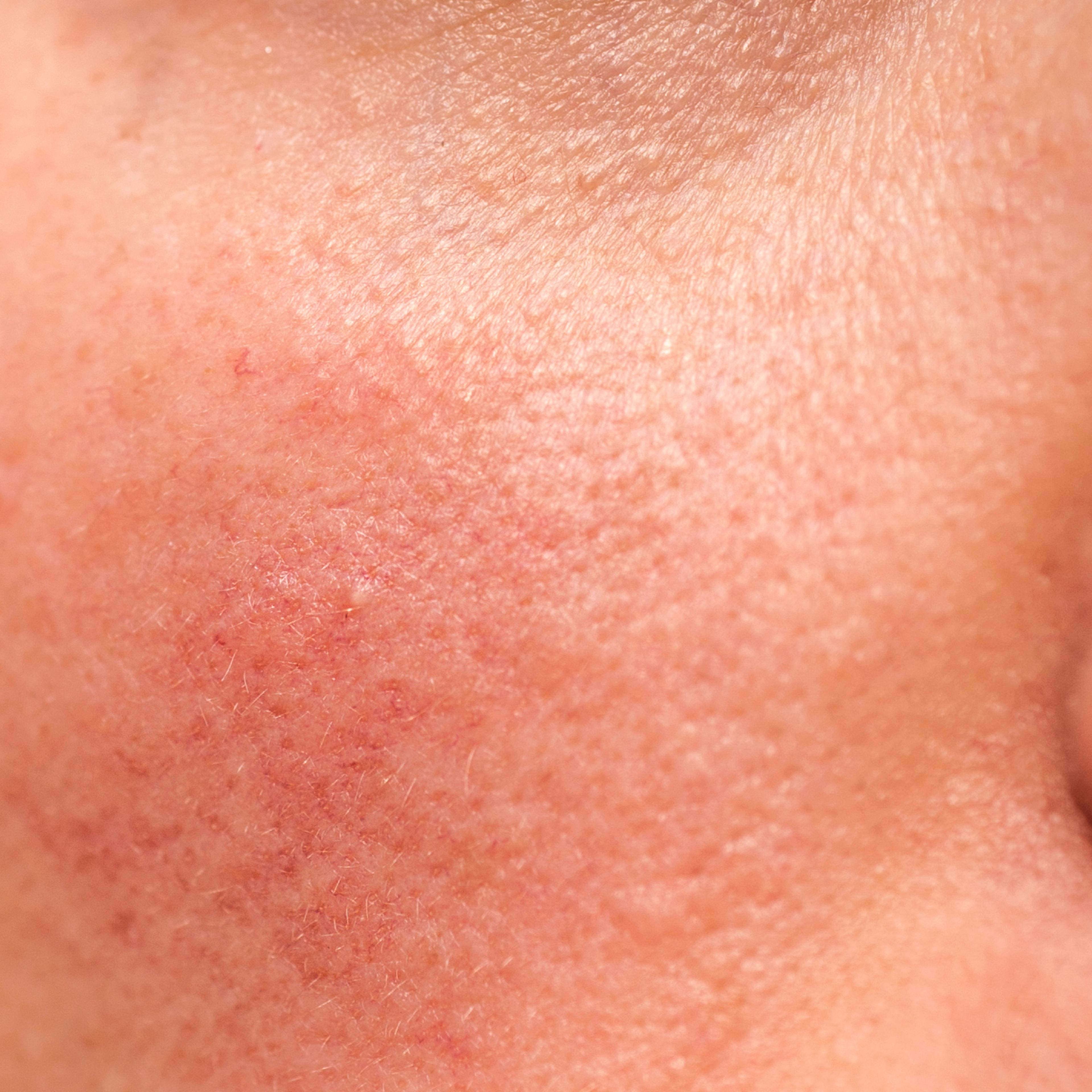 Rosacea on Skin TIME health stock