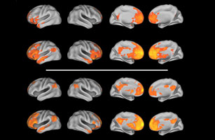 Study: Some Autistic Brains Really Are Wired Differently