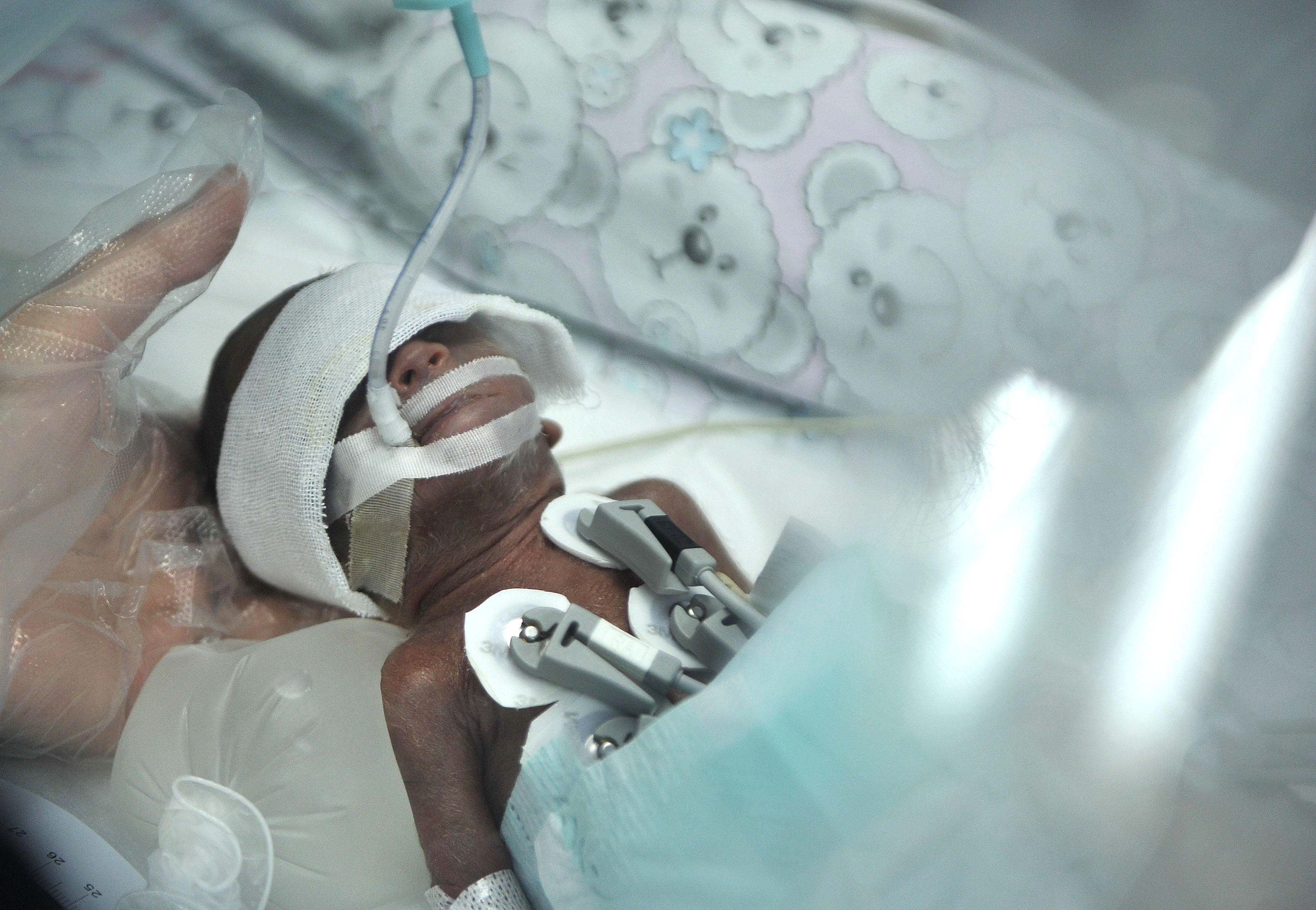 A pound and a half of life: This baby was born in 2014 at 23 weeks in Sichuan China.