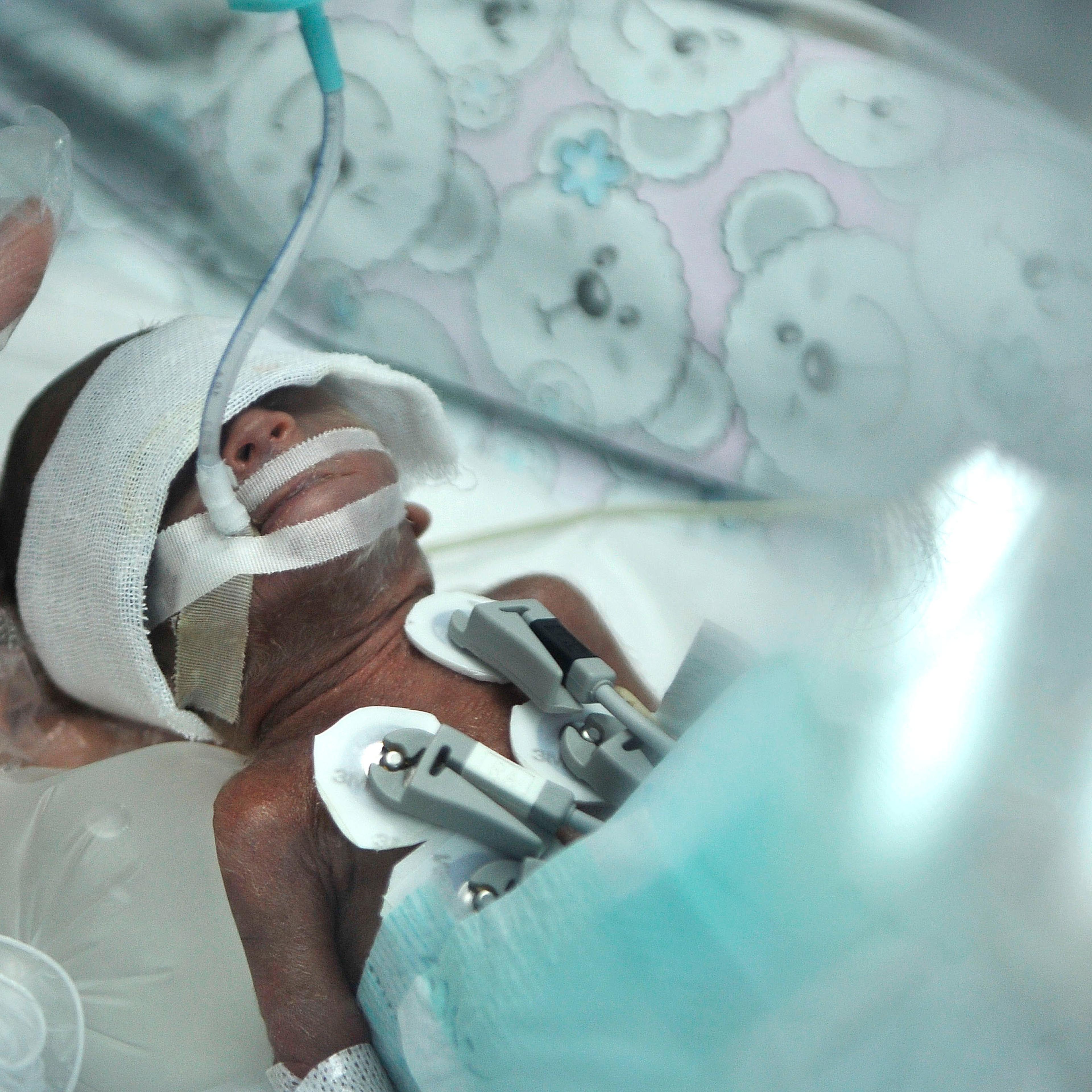 A pound and a half of life: This baby was born in 2014 at 23 weeks in Sichuan China.