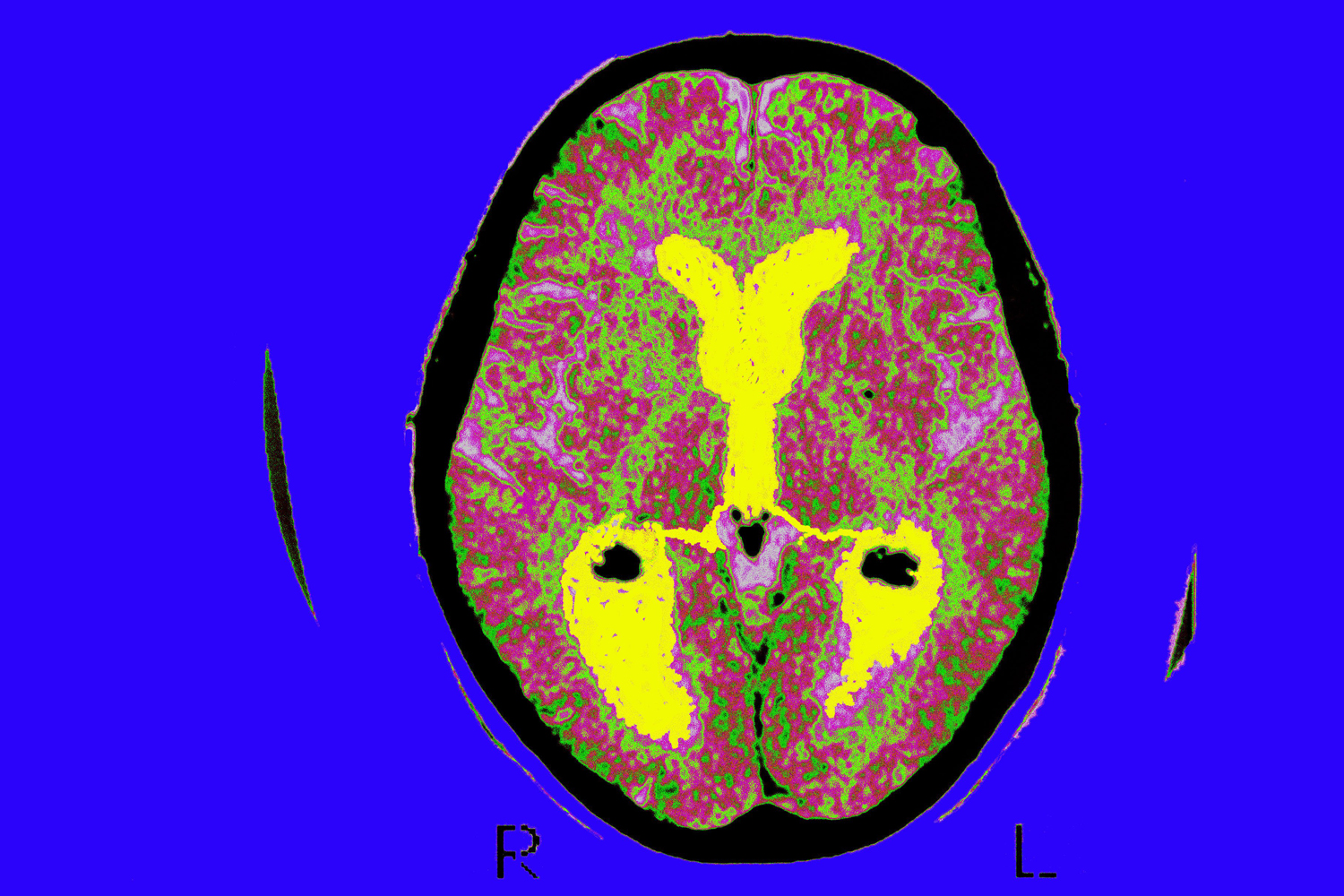 Brain of a patient affected by Alzheimers disease
