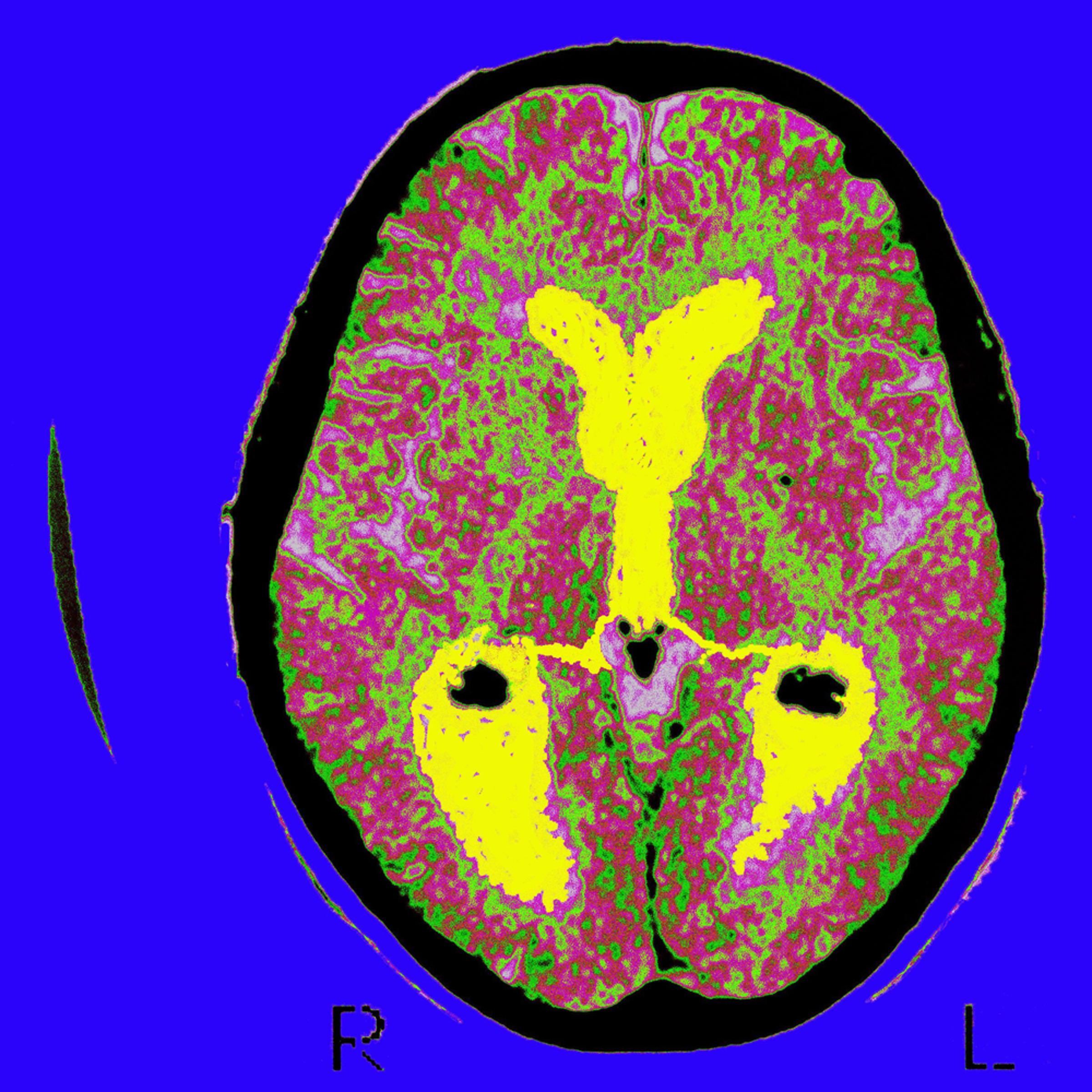 Brain of a patient affected by Alzheimers disease