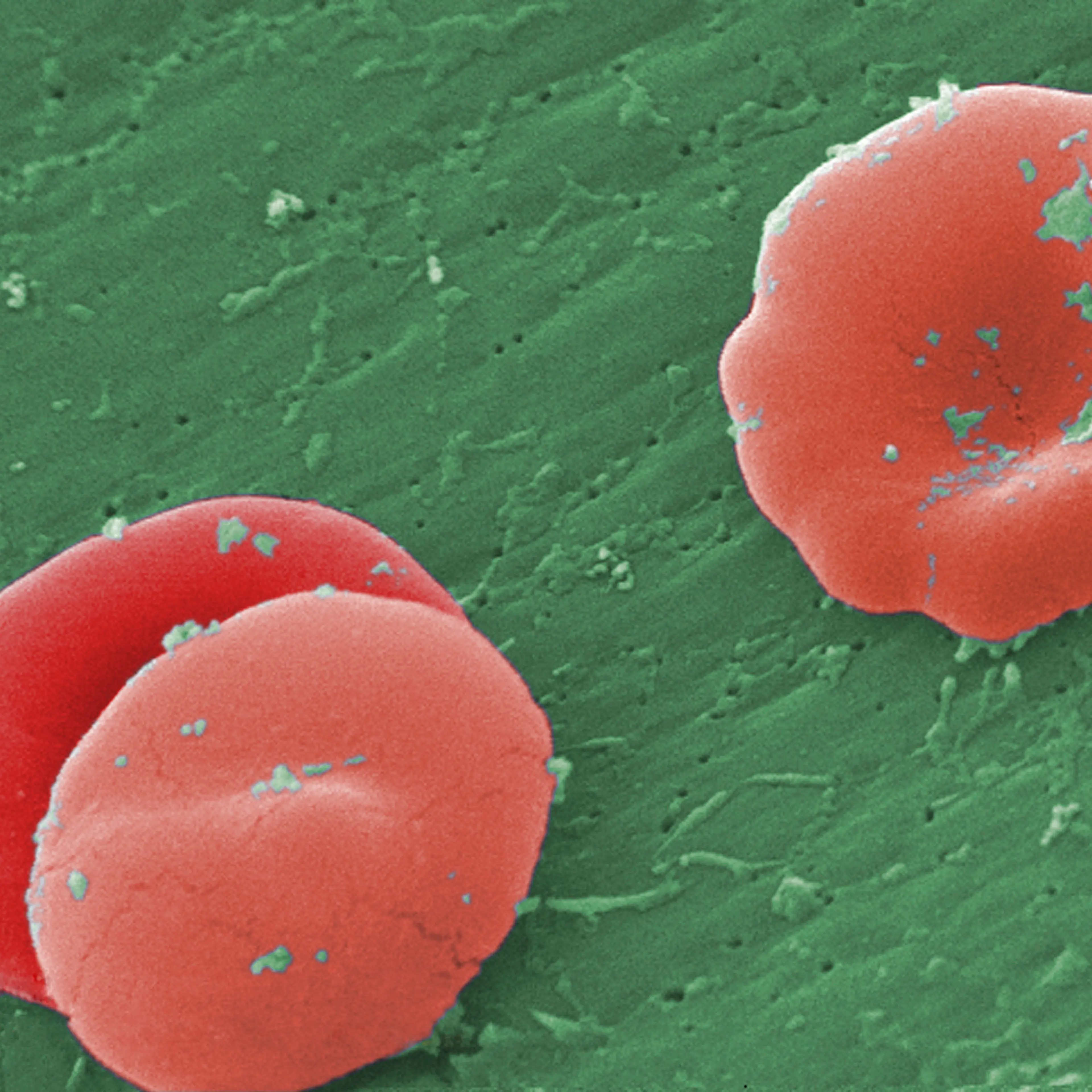 Sickle Cell Anemia SEM