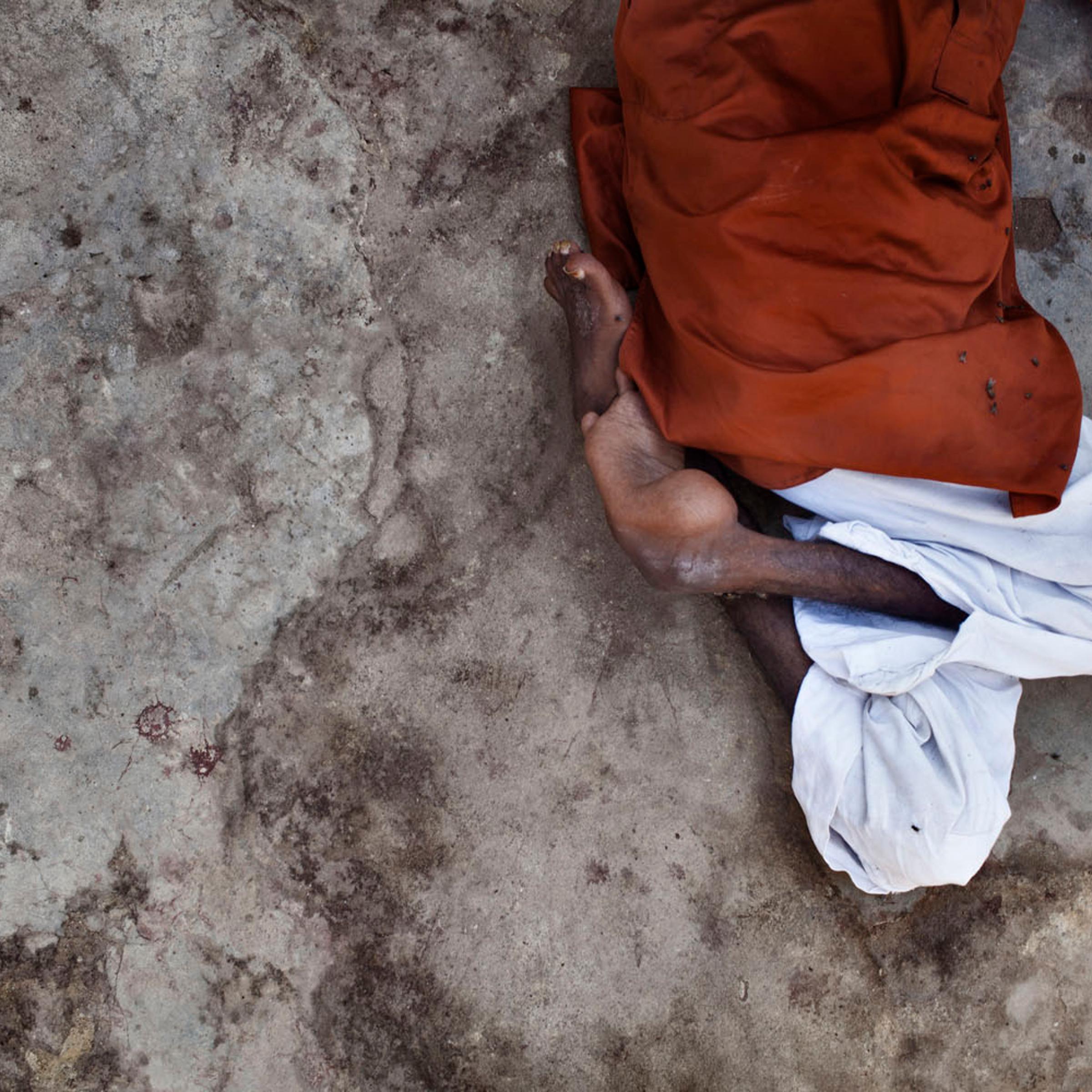 Image: Latif, son of Jam Pumhoom, got polio when he was 8 years old
