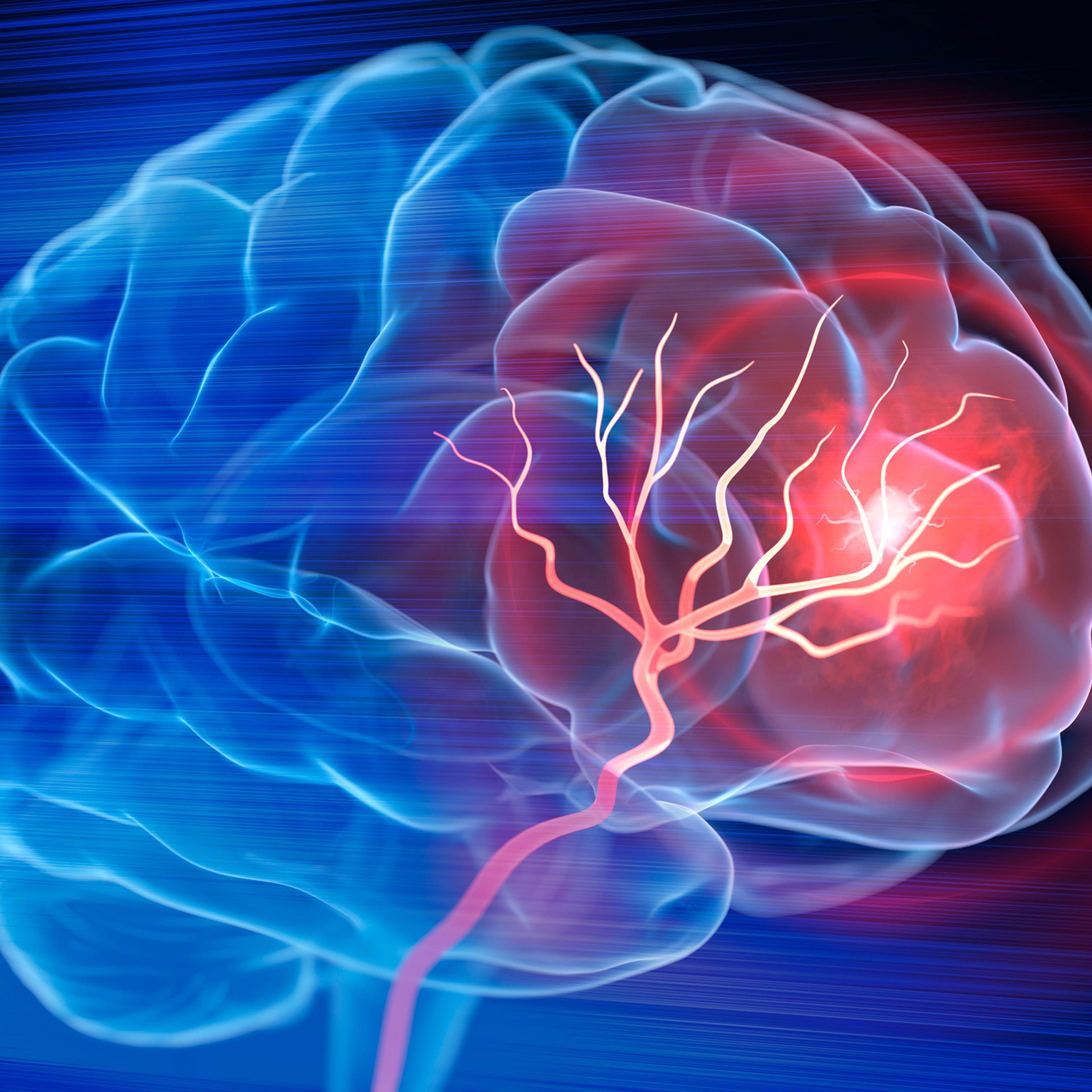 Brain stroke