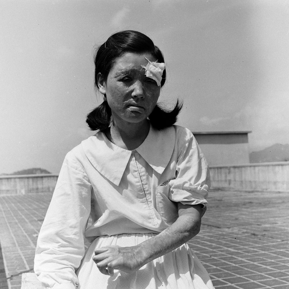 <strong>Not published in LIFE.</strong> Young survivor of the United States' atomic attack on Hiroshima, Japan, 1947.