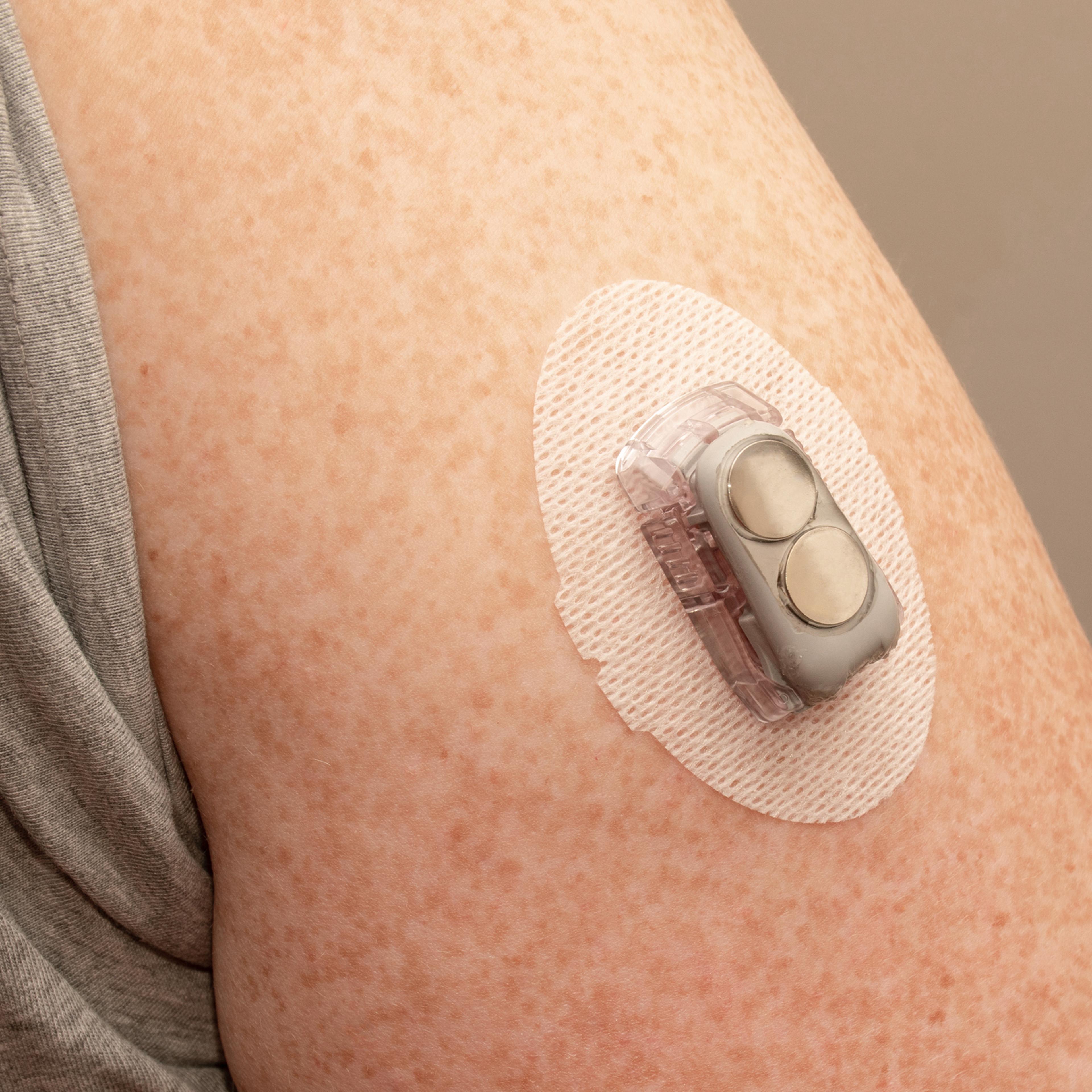CGM - Continuous glucose monitoring: senso installed on the upper arm. Transmitter with replaced batteries